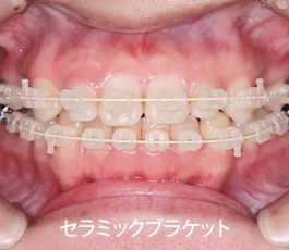 セラミックブラケット